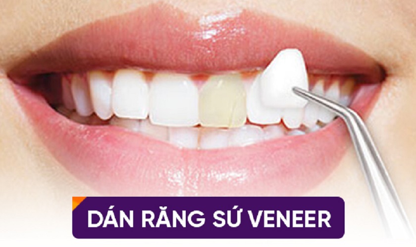 Trả lời: Răng sứ Veneer có tốt như tin đồn không? Dịch vụ bọc răng sứ tốt tại HCM ở đâu?